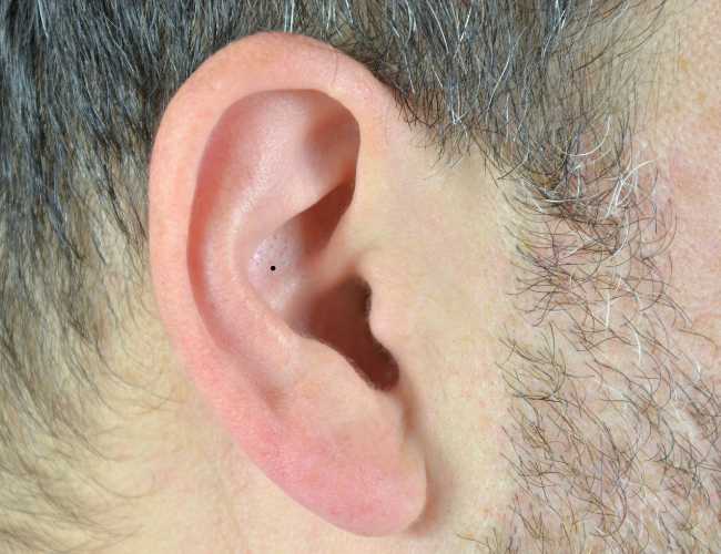 Vị Trí Nốt Ruồi Ở Tai Nam Nữ Nói Lên Điều Gì?