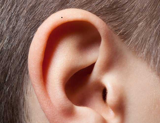 Vị Trí Nốt Ruồi Ở Tai Nam Nữ Nói Lên Điều Gì?