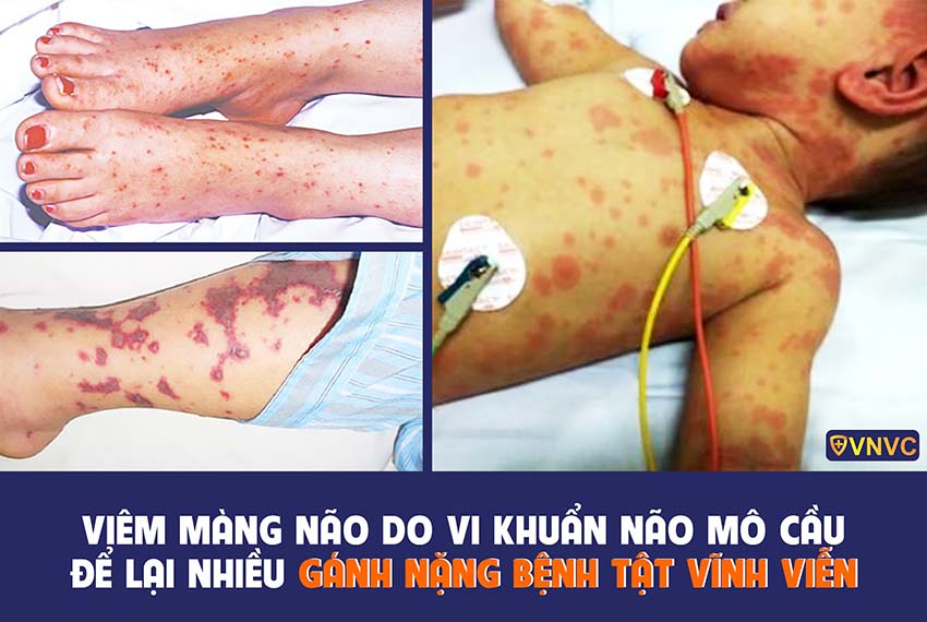 Vắc xin MENACTRA phòng bệnh do vi khuẩn não mô cầu tuýp A,C,Y,W