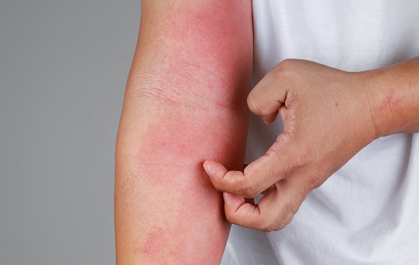 Khi nào cần khám khoa da liễu?